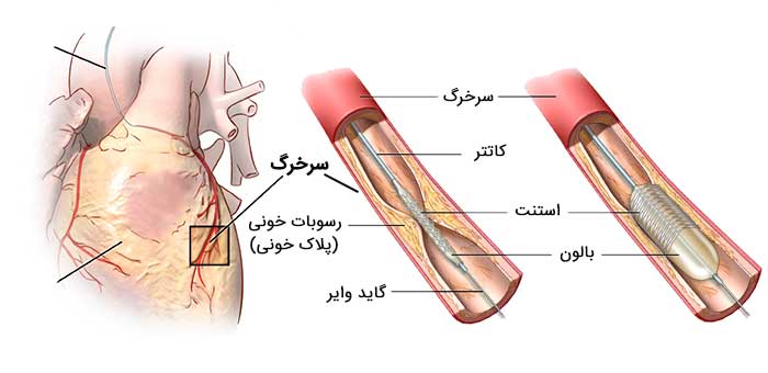 1731138106 312 آنژیوگرافی قلب چیست و چگونه انجام می‌شود؟ - آنژیوگرافی قلب چیست و چگونه انجام می‌شود؟