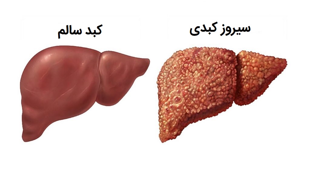 آزمایش SGPT یا ALT در آزمایش خون